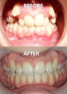 Orthodontic-Before-After