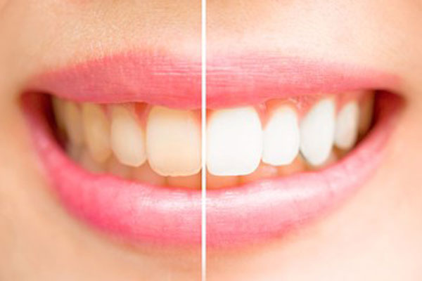 Teeth-whitening-comparison