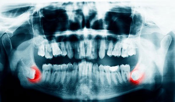 Wisdom teeth X-Ray